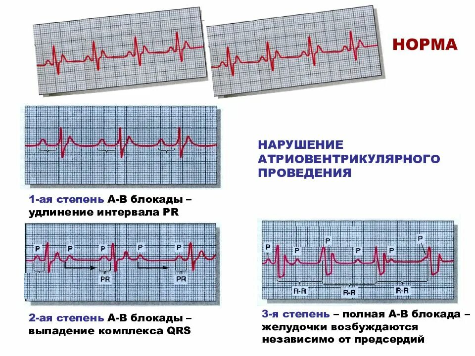Удлинение комплекса qrs