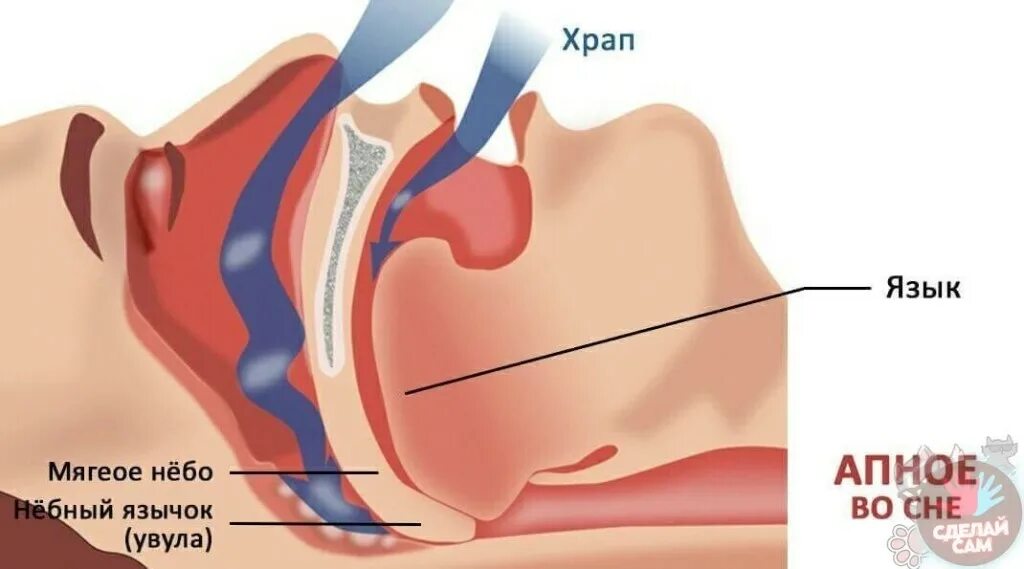 удаление храпа