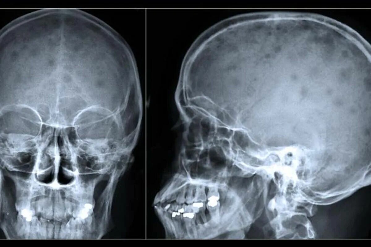 Кости черепа рентген. Миеломная болезнь рентген черепа. Миеломная болезнь кости черепа рентген. Миеломная болезнь костей черепа. Миеломная болезнь кости черепа.