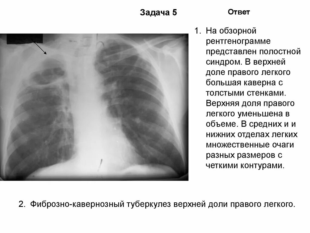 Доли легкого на рентгенограмме. Туберкулёз верхней доли левого легкого рентгенограмма. Туберкулез верхней доли правого легкого. Туберкулез нижней доли легких. Туберкулез нижней доли правого легкого.