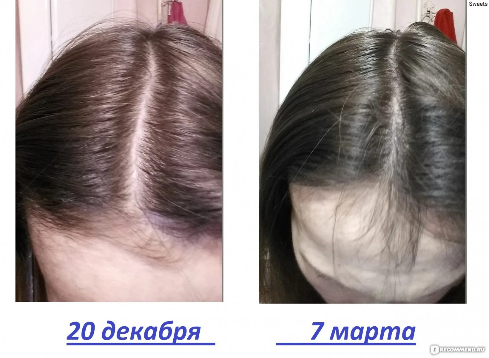 Дарсонваль волосы до и после отзывы Отзыв о Аппарат для местной дарсонвализации Новатор "Корона" Как я лечила дарсон