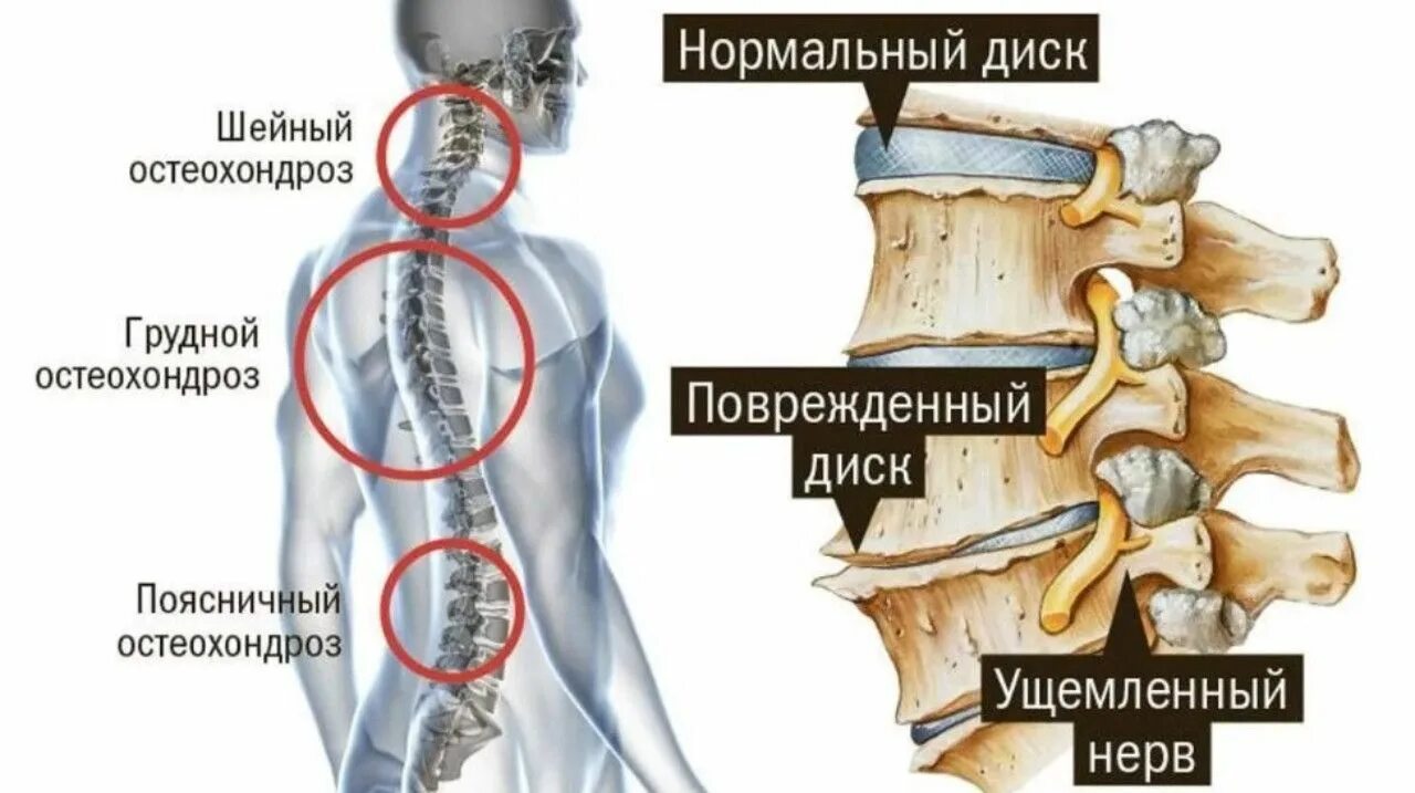 Как лечить поясничного отдела позвоночника. Остеохондроз пояснично-крестцового отдела шейного и грудного отдела. Шейный остеохондроз позвонки шейного отдела. Межпозвоночный остеохондроз грудного отдела симптомы. Остеохондроз шейный грудной поясничный.