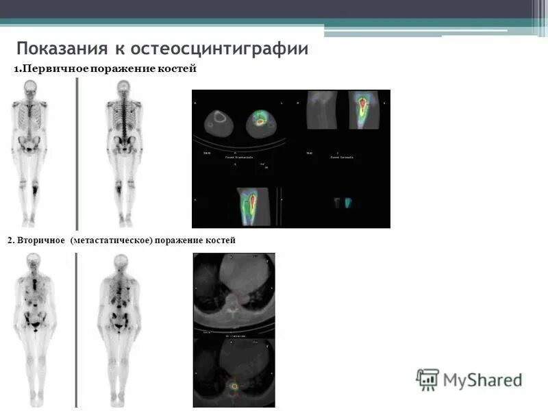 Метастатическое поражение кости. Остеосцинтиграфия бедренной кости. Показания к остеосцинтиграфии. Остеосцинтиграфия в норме. Показания остеосцинтиграфии костей.