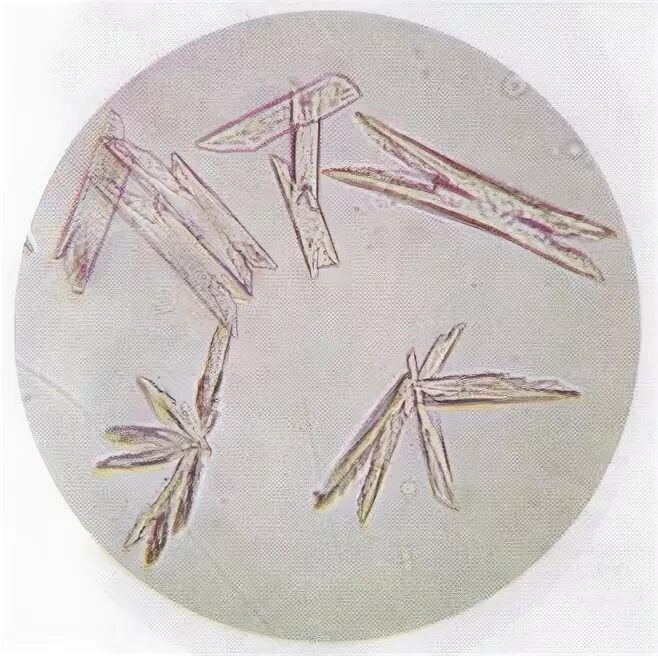 Иглы в моче. Аморфные трипельфосфаты. Сульфат кальция в моче микроскопия. Фосфорнокислая известь в моче микроскопия. Сернокислый кальций в моче микроскопия.
