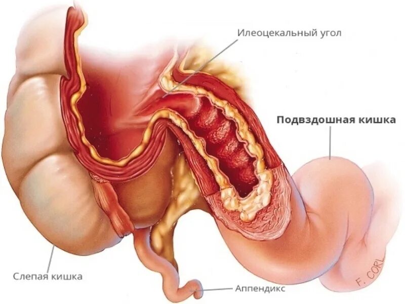 Правая подвздошная кишка. Илеоцекальный клапан анатомия. Илеоцекальный клапан баугиниева заслонка. Подвздошная кишка анатомия. Илеоцекальный клапан толстой кишки.