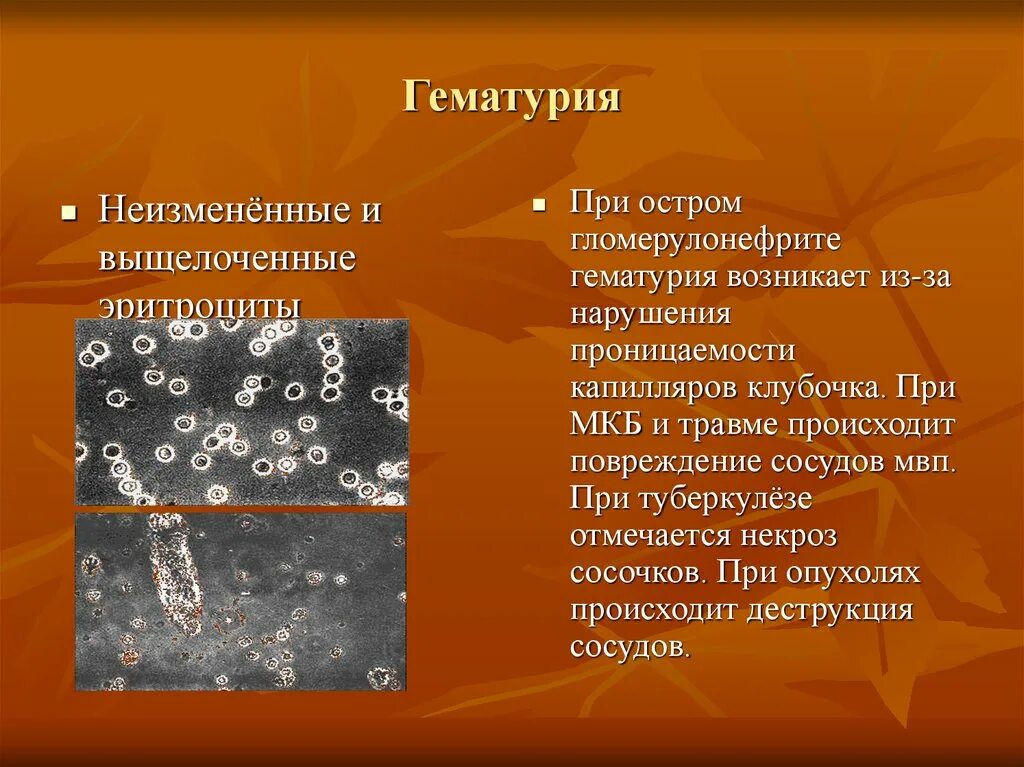 Гематурия при каких заболеваниях. Гематурия при каких заболеваниях