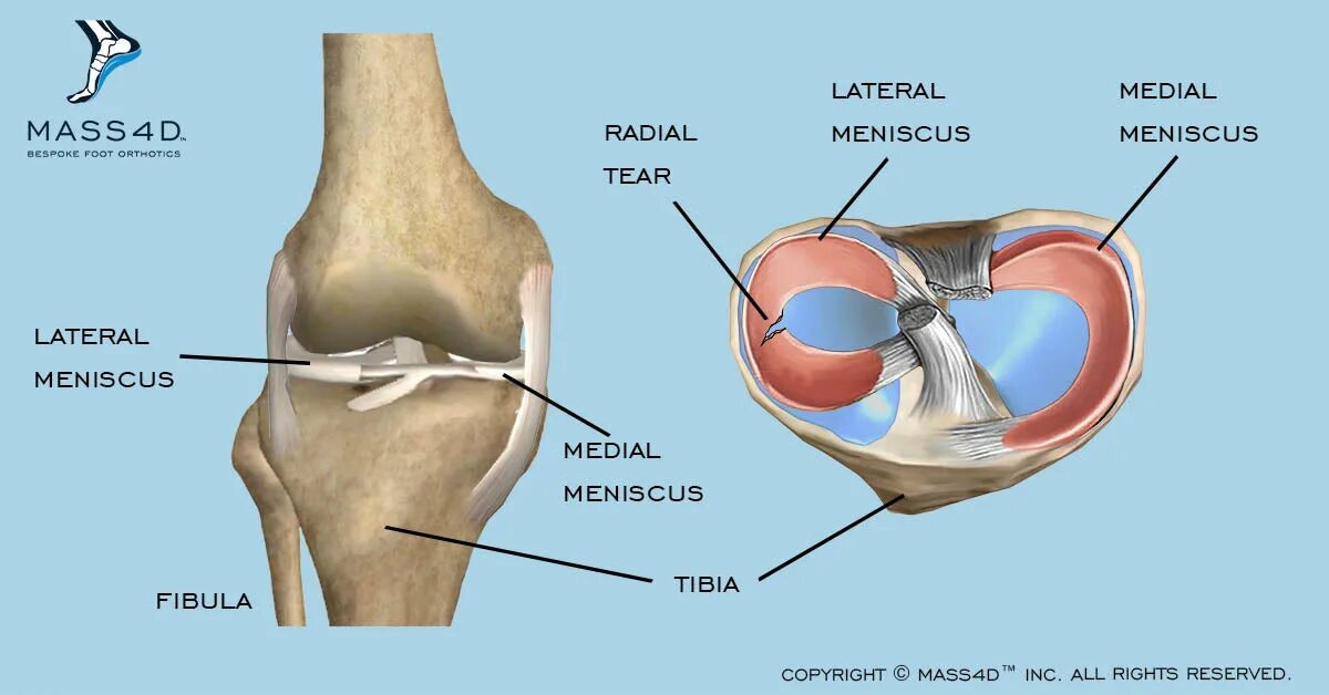 Медиальный мениск коленного сустава. Коленный мениск анатомия. Разрыв мениска коленного сустава. Разрыв медиального мениска коленного сустава.