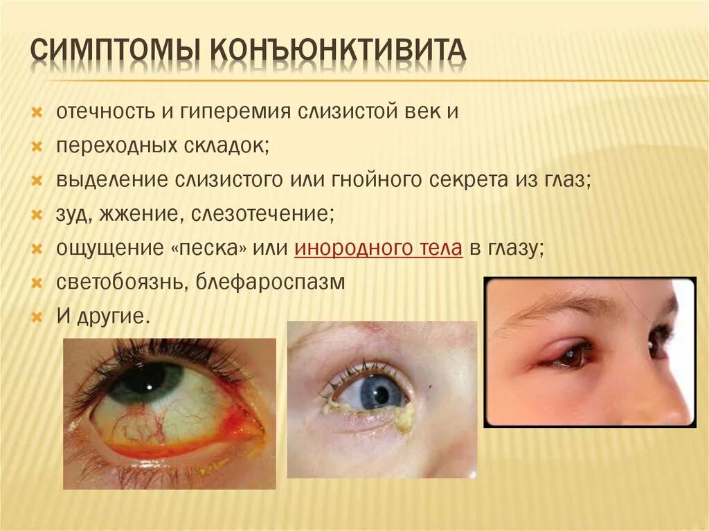 Болит глаз месяц. Конъюнктивит симптомы вирусный конъюнктивит. Глазное заболевание конъюнктивит симптомы. Конъюнктивит у взрослых симптомы. Вирусный конъюнктивит симптомы.