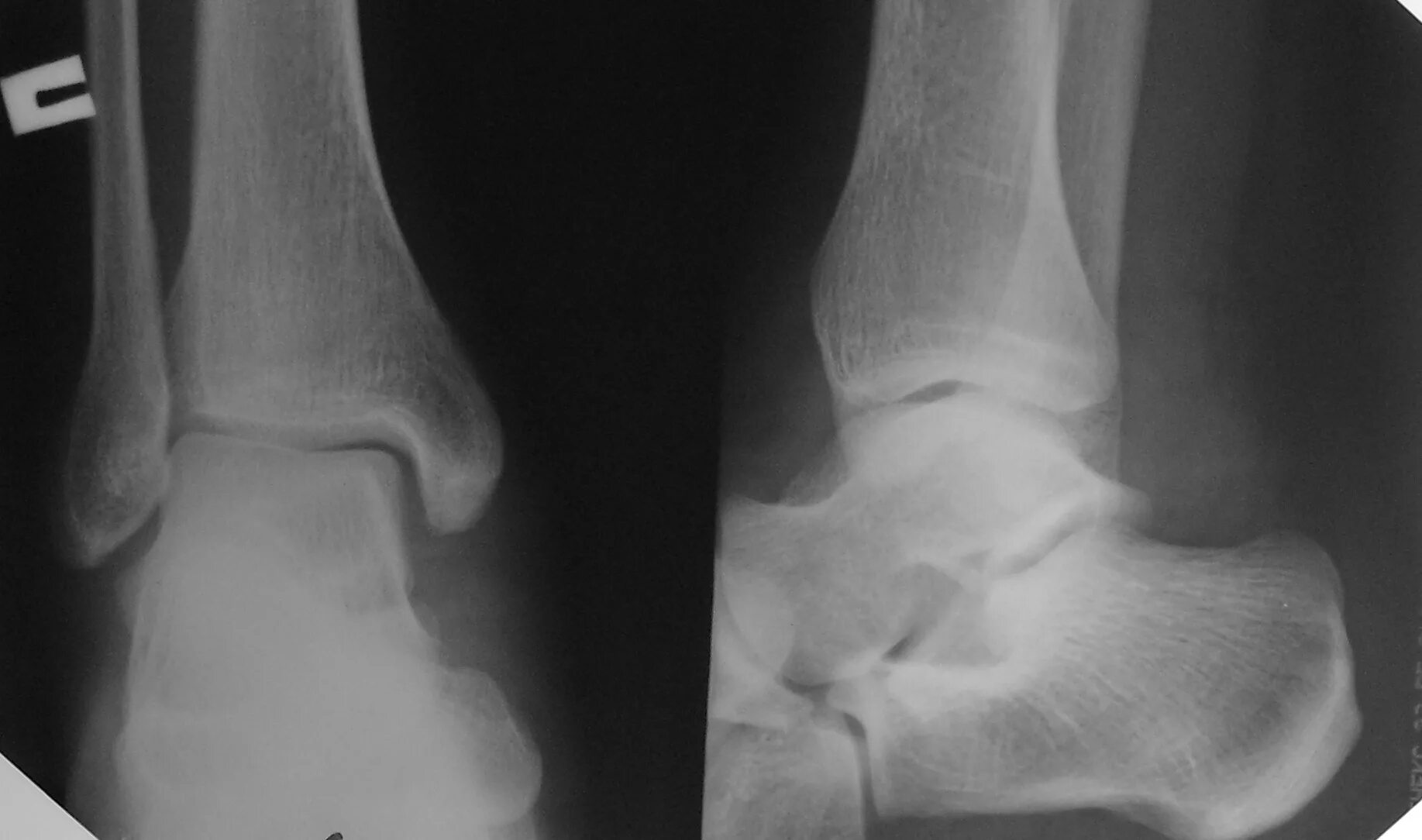 Двойной перелом лодыжки. Кортикальный перелом лодыжки. Лодыжка без смещения. Лодыжка без смещения. Перелом лодыжки без смещения гипс.