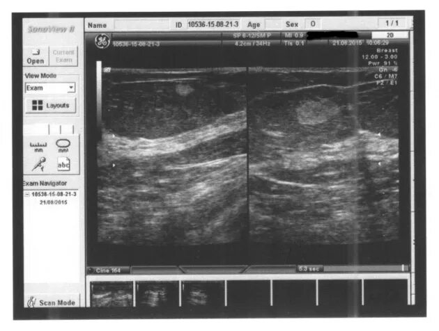 гиперэхогенное образование в молочной. липома молочной железы узи картина. гиперэхогенные образования молочной железы узи. гиперэхогенное образование молочной железы на узи. фиброаденомы молочной железы гипоэхогенное образование.