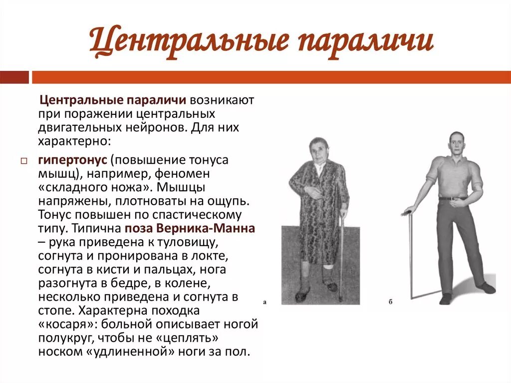 Почему руки парализовало. Симптомы центрального спастического паралича. Тонус мышц при Центральном параличе. Левосторонний Центральный гемипарез очаг поражения. Центральный парез пирамидной системы.