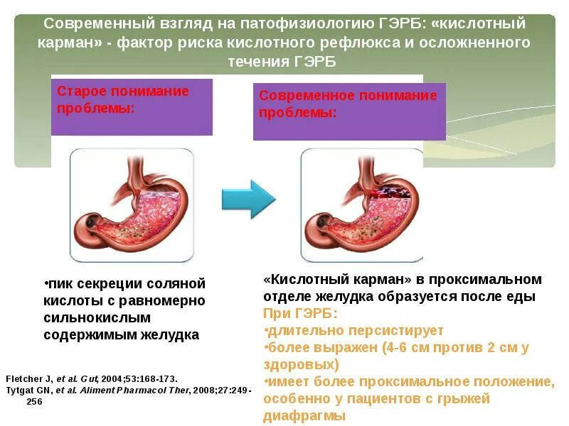 Классификация рефлюкса. Гастроэзофагеа́льная рефлю́ксная боле́знь. Кислотный карман при ГЭРБ. Профилактика гастроэзофагеальной рефлюксной болезни.