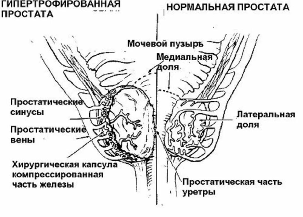 Какие размеры предстательной железы норма. Предстательная железа размеры47х37х42. схема простаты у мужчин. возрастные нормы объема предстательной железы. норма объема предстательной железы у мужчин по возрасту таблица.