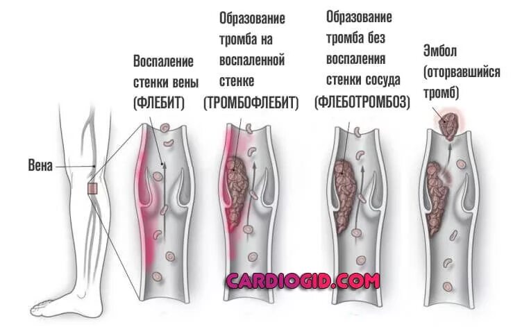 Чем отличается тромбоз. Тромбофлебит и флеботромбоз отличия сравнительная. Тромбофлебит глубоких вен дифференциальная диагностика. Тромбофлебит поверхностных вен нижних конечностей. Тромбофлебит поверхностных вен голени.