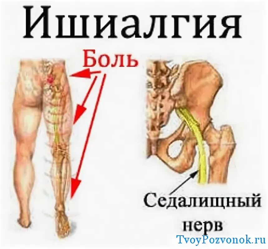 Боль поясница слева отдает в ногу. Люмбоишиалгия поясничного отдела позвоночника. Седалищный нерв симптомы. Боль по седалищному нерву.