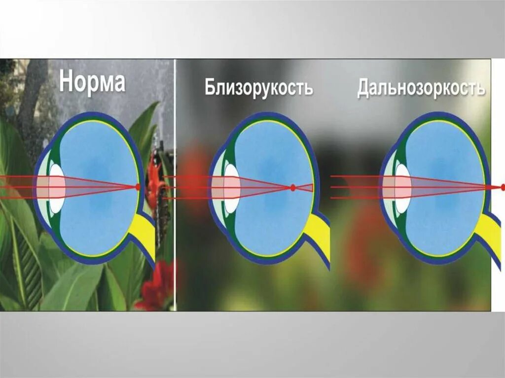 Близорукость и дальнозоркость. Глаз и зрение оптические приборы. Миопия и гиперметропия. Глаз и оптические приборы дефекты зрения. Как видят дальнозоркие люди