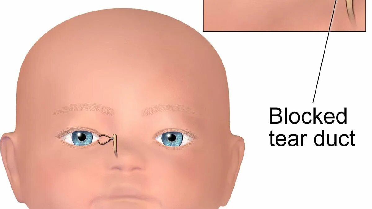 Массаж слезного канала видео. Воспаление носослезного канала у новорожденных. Расположение слезного канала у новорожденных. Непроходимость слезного канала у младенца. Массаж слезного канала у новорожденных.