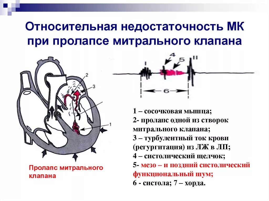 Сердечная недостаточность митрального клапана. Относительная недостаточность митрального клапана. Шум относительной недостаточности митрального клапана. Систолический щелчок при пролапсе митрального клапана. Недостаточность митрального клапана аускультация схема.