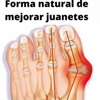 Hallux valgus что это такое