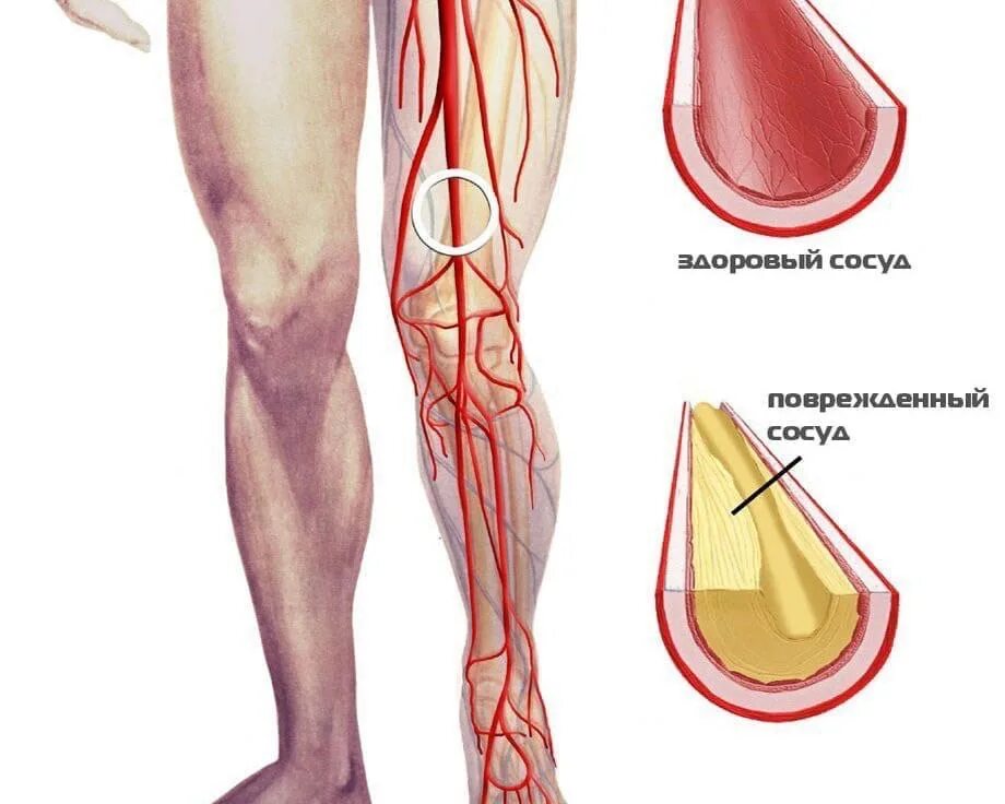 Облитерирующий атеросклероз сосудов конечностей. Облитерирующий атеросклероз ног. Окклюзионных заболеваний артерий нижних конечностей. Тромбоз подколенной артерии. Операция шунтирование ног