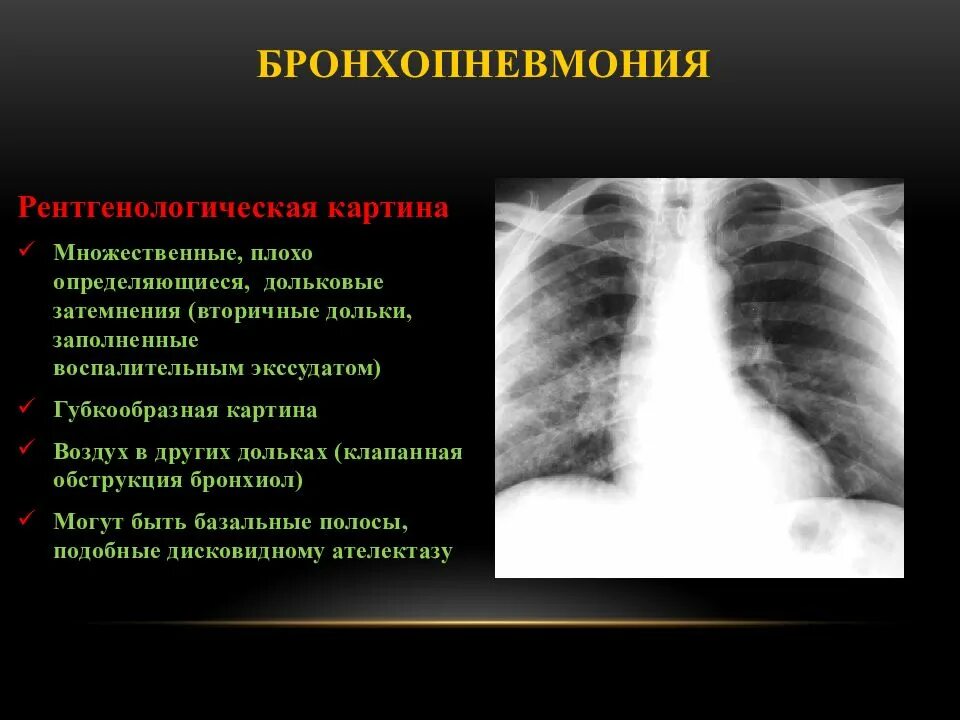 Бронхопневмония у детей описание рентгенограммы. Рентген признаки бронхопневмонии у детей. Катаральная бронхопневмония на рентгене. Бронхопневмония у детей рентген.