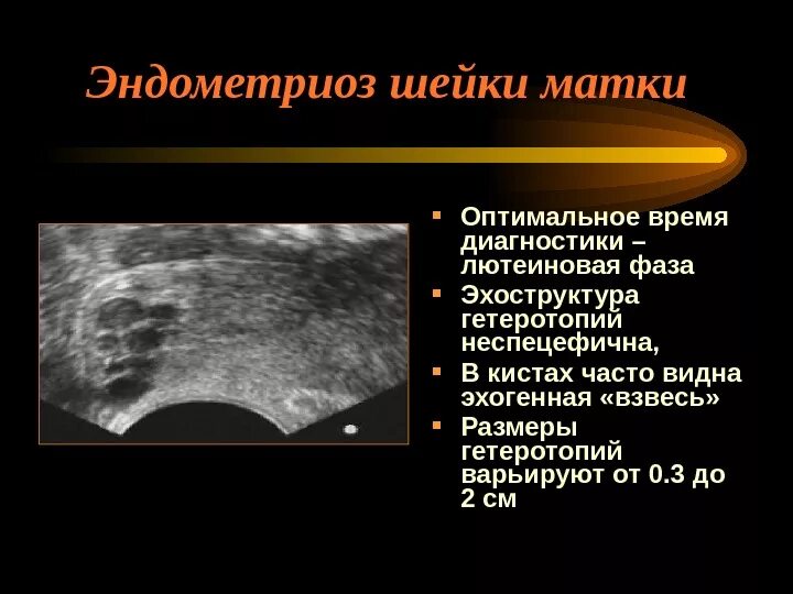 Диффузные изменения по типу эндометриоза. Узи признаки эндометриоза матки. эндометриоидные кисты шейки матки на узи. эндометриоидная киста шейки матки на узи. узи критерии внутреннего эндометриоза.