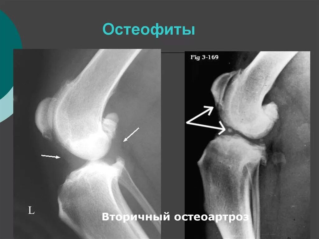 Остеофиты что это такое и как лечить. Остеофит бедренной кости. Краевые остеофиты коленного сустава рентген.