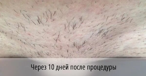Лазерная эпиляция волосы выпадают через. Волосы после лазерной эпиляции. волоски после лазерной эпиляции. выпадение волос после лазерной эпиляции.