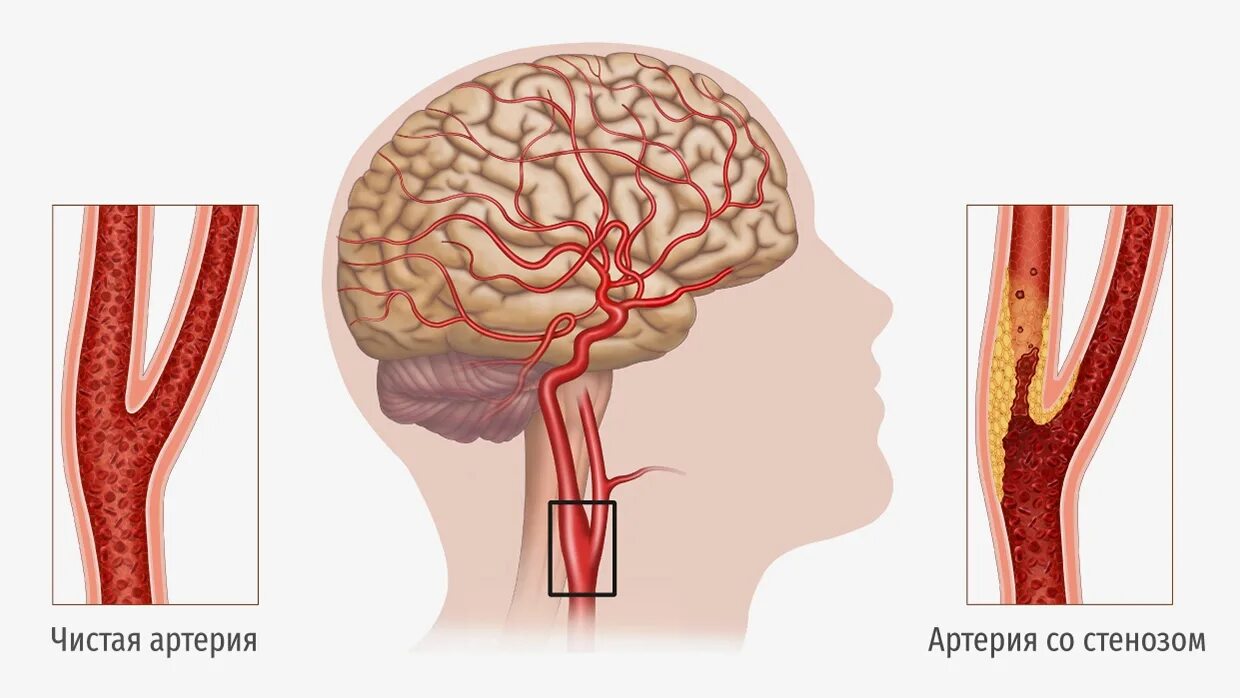 Атеросклероз сосудов сонных артерий. Атеросклероз сосудов шеи сонных артерий. Облитерирующий атеросклероз сонных артерий. Стентирование сонной артерии. Закупорка головных сосудов