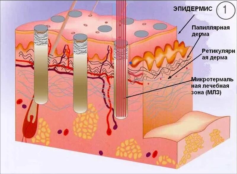Процедура фракционного лазера. Фракционное омоложение лазером co2. глубина лазера co2 кожи. лазерная шлифовка deka co2.