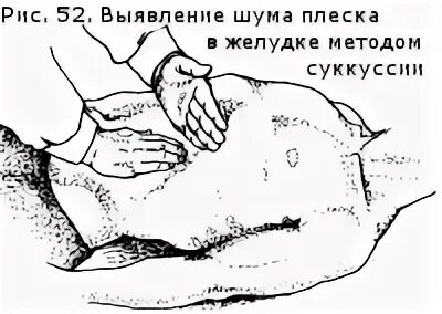 Плеск в желудке