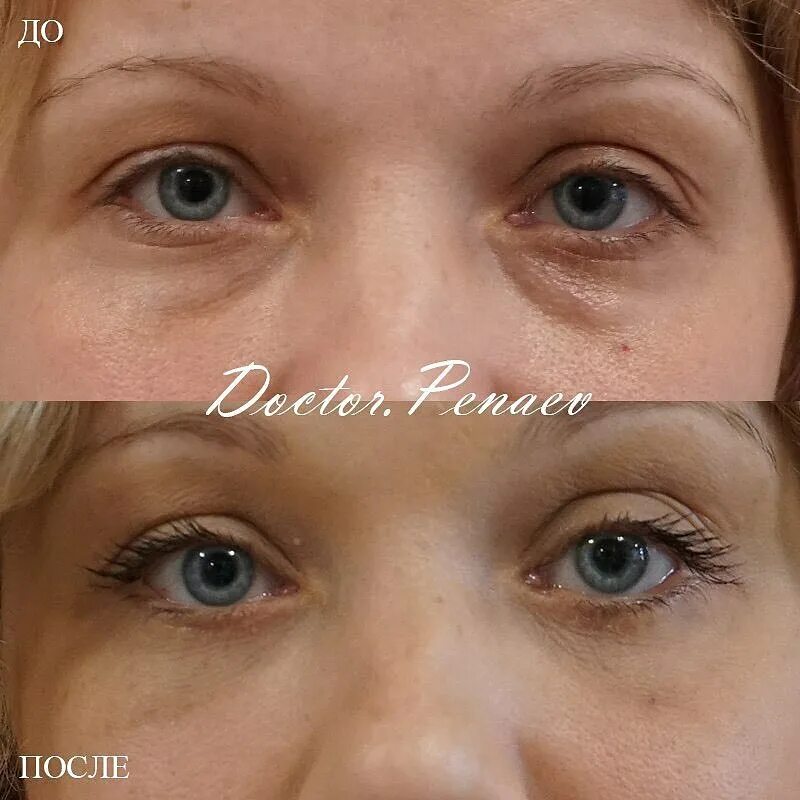 Птоз лица после ботокса. Птоз верхнего века после операции. Ботокс птоз верхнего века. Ботокс птоз верхнего века. Птоз век после ботокса.