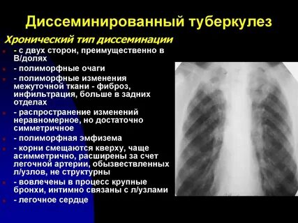 Диссеминированного туберкулеза легких