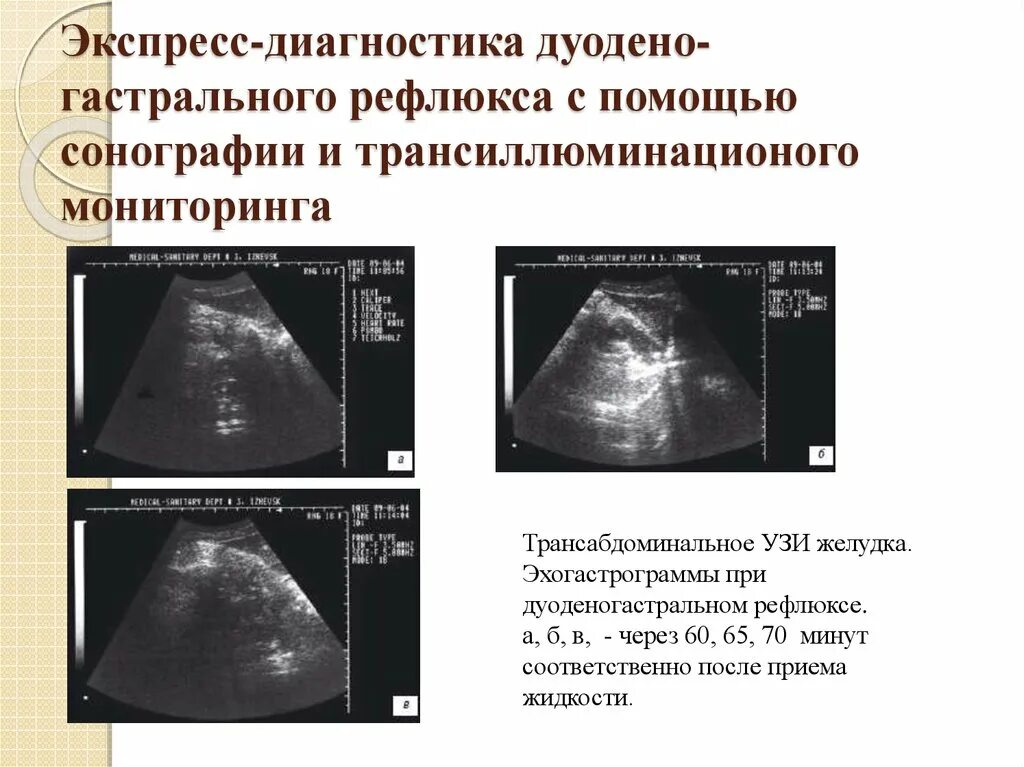 Диагностика рефлюкса. Трансабдоминальное УЗИ желудка. Рефлюкс на УЗИ. Гастроэзофагеальный рефлюкс на УЗИ.