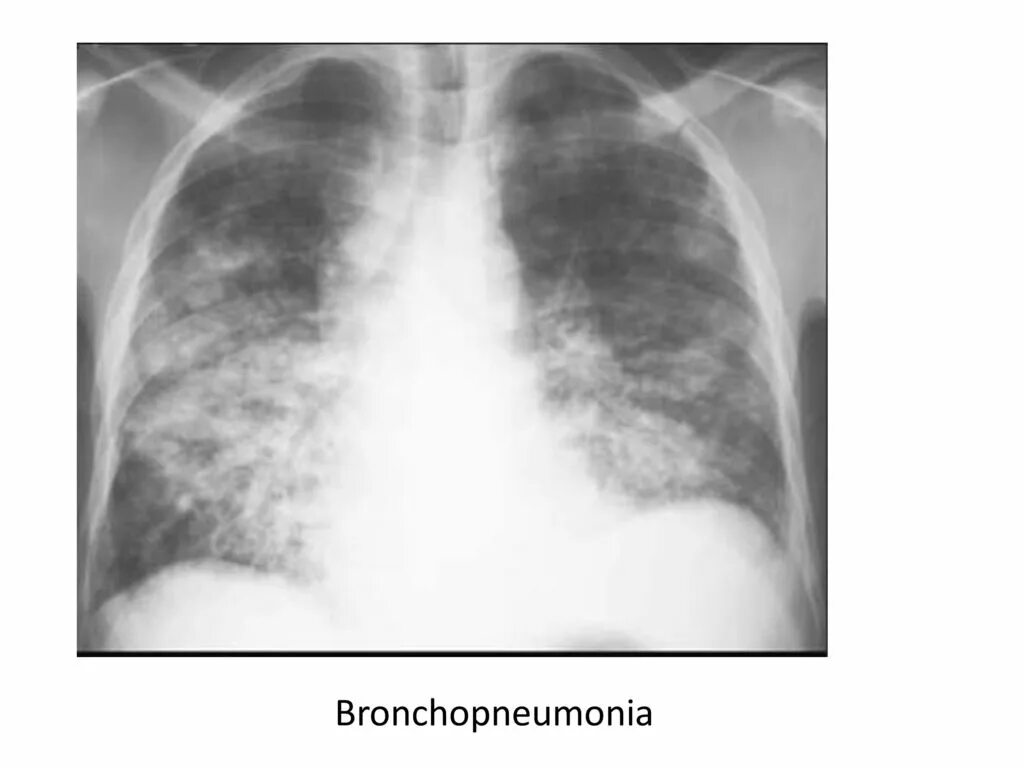 Очаговая пневмония рентген. Правосторонняя бронхопневмония рентген. Бронхопневмония пневмония. Рентген легких с бронхопневмонией.