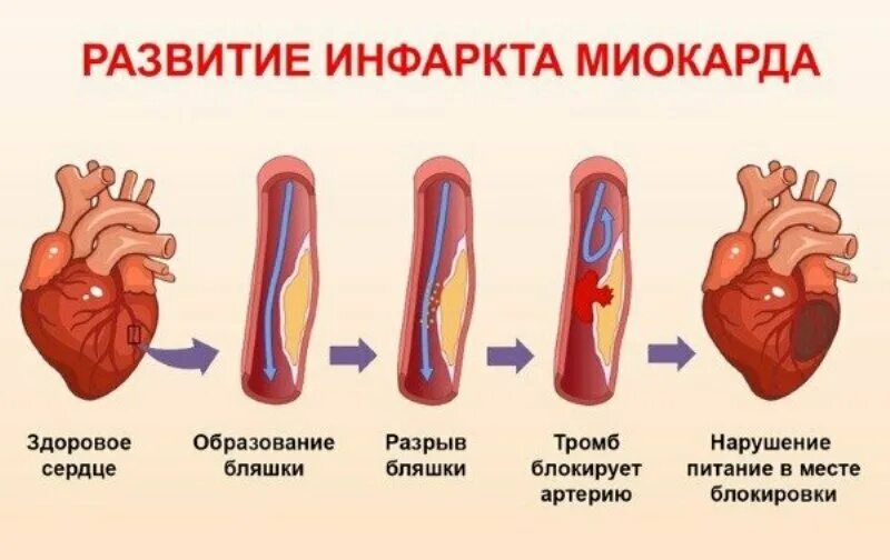 Что происходит с сердцем при инфаркте. Причины развития острого инфаркта миокарда. образование тромба при инфаркте миокарда. симптомы ибс инфаркт миокарда. процесс развития инфаркта миокарда.