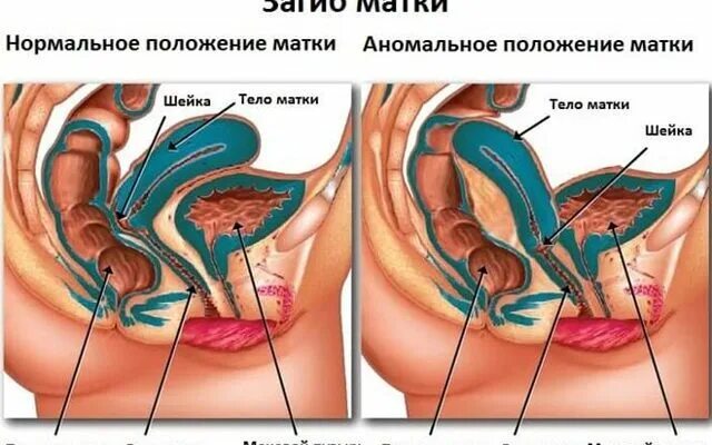 Расположение матки retroflexio. Изгиб матки. Шейка матки загиб кзади. Расположение матки anteflexio.