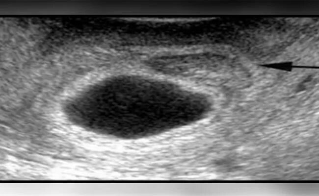 Беременность 2 недели плодное яйцо. При отслойке плодного яйца. Плодное яйцо на раннем сроке.