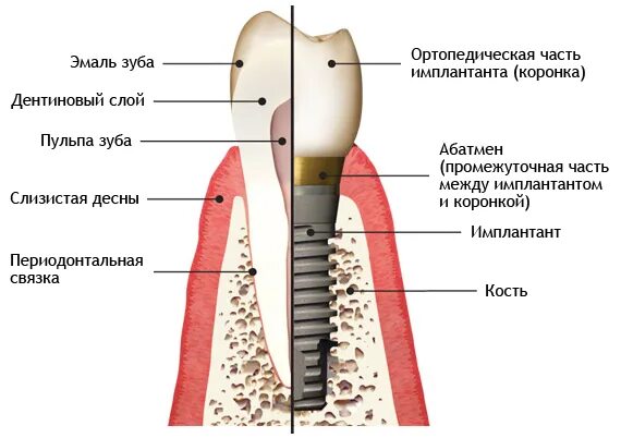 Абатмент - Olphoto.ru