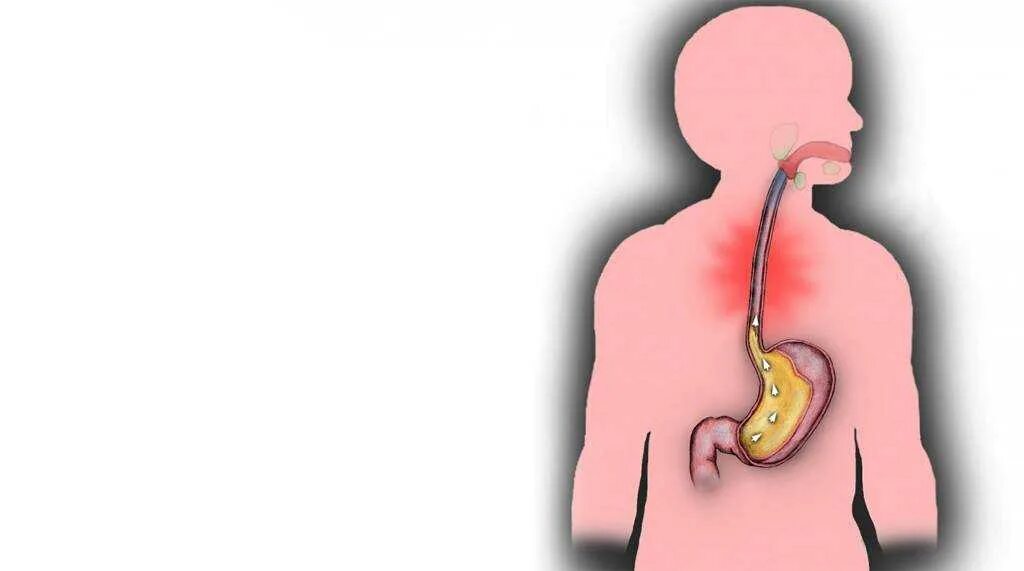 Еда в пищеводе. Гастрит рефлюкс эзофагит. Эзофагит рефлюкс кислотный. Рефлюкс эзофагит клиника. Эзофагит гастродуоденит.