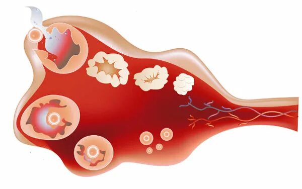 Антимюллеров гормон. Фолликулярный запас яичников. Фолликулярный резерв яичников. Овариальный резерв яичников. Болят яичники стимуляция