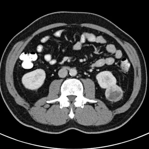 Кисты почек кт Босниак. Bosniak классификация кист почек кт. Классификация Босняк кт.