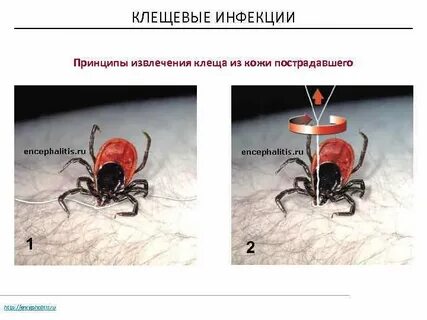Клещевые инфекции