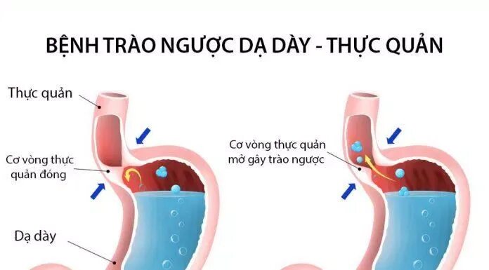 Дуоденогастральный рефлюкс желчи. Дуодено-гастральный рефлюкс 2ст. Дуодено-билиарный рефлюкс. Дуодено панкреатический рефлюкс. Препараты при рефлюксе желудка