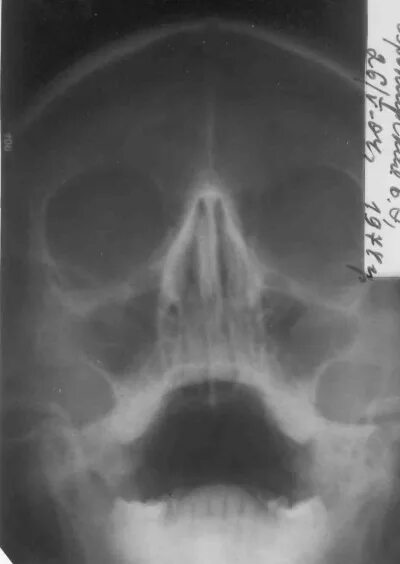 отсутствие пазухи. недоразвитие лобных пазух рентген. отсутствие пазухи. пристеночный гайморит рентген. отсутствие пазухи.