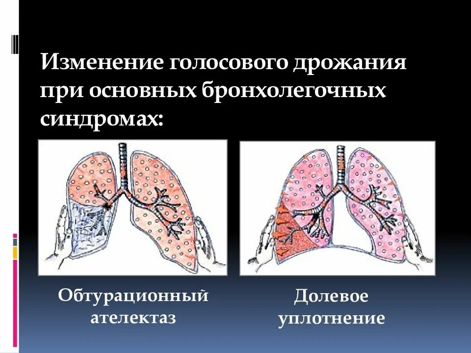 Усиленное голосовое дрожание. Изменение голосового дрожания при основных легочных синдромах. Синдром обтурационного ателектаза. Голосовое дрожание при основных бронхолегочный синдромах. Голосовое дрожание изменения при.