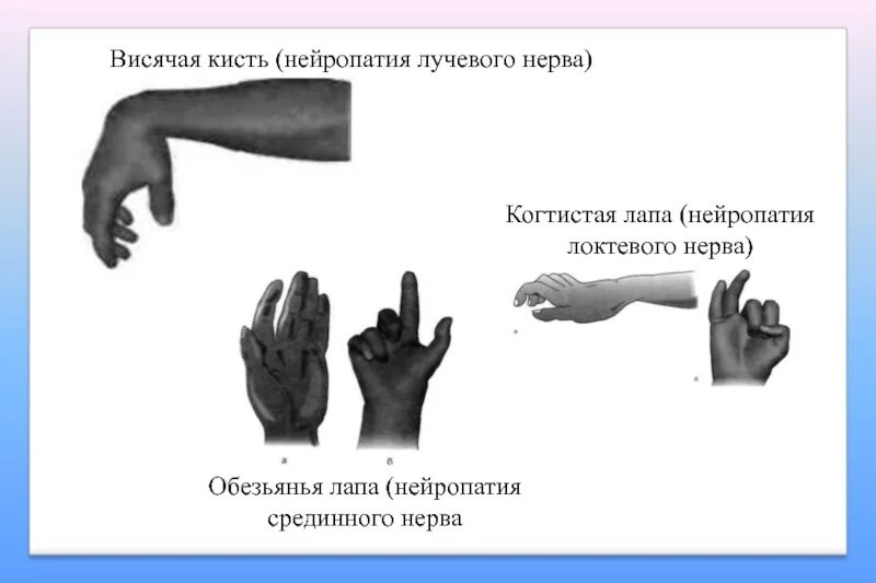 Повреждение локтевого нерва. Невропатия локтевого нерва кисть. Вид кисти при поражении локтевого нерва. Синдром поражения срединного нерва. Кисть при нейропатии срединного нерва.