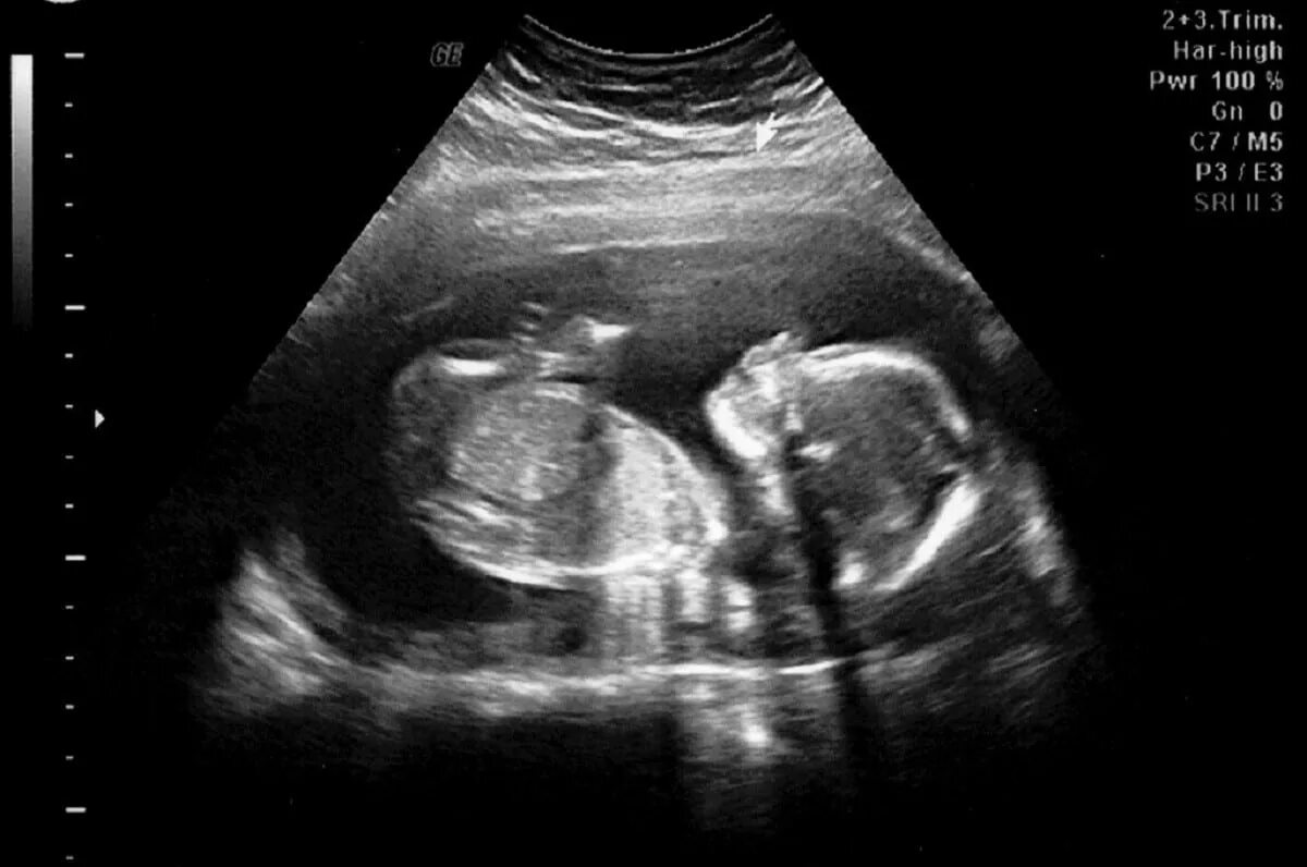 19 недель 3 дня. Узи малыша. узи беременной девушки. узи 20 недель беременности фото.