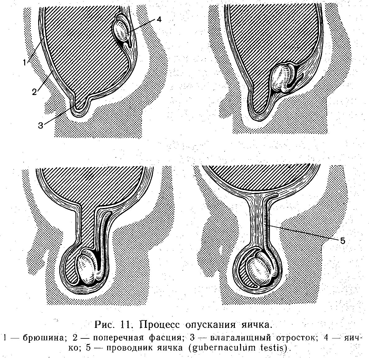 Опущение яичка в мошонку. Процесс опускания яичка в мошонку анатомия. Не опускаются яички что делать