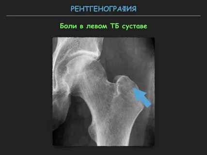 Мкб тазобедренных суставов